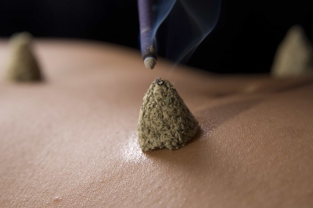 Moxibustion Technique