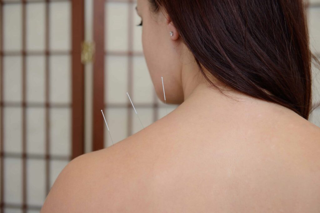 Acupuncture in Paignton Darren Stoyle